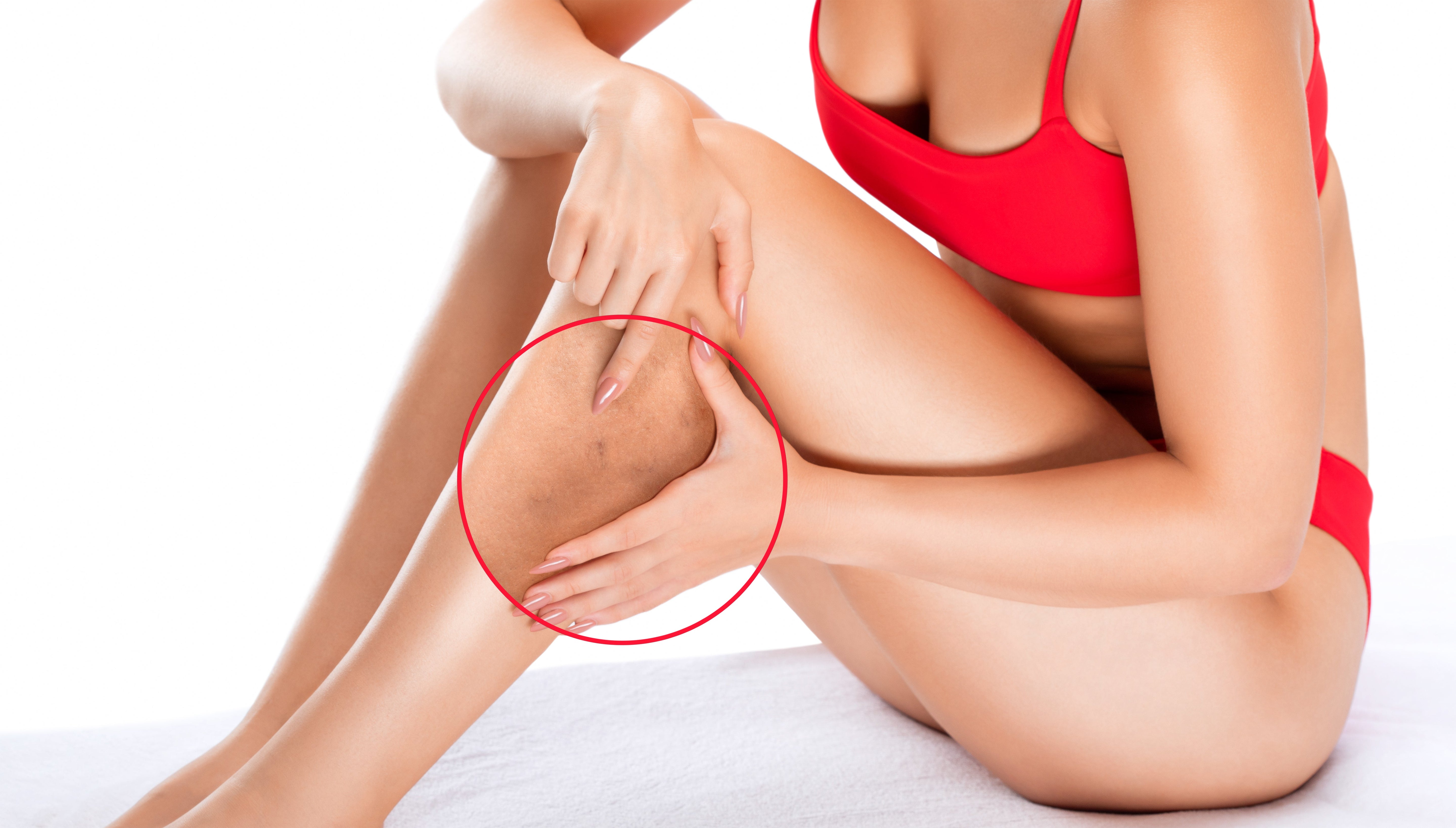 What Causes Spider Veins? A Doctor's Guide to Prevention and Relief